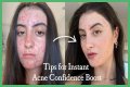 How To Feel Confident With Acne?